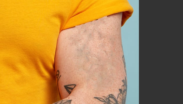 Remove a tattoo from a photo: remove blue from tattoo.
