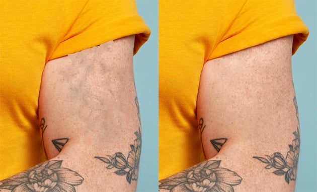 Remove a tattoo from a photo: use the healing brush.